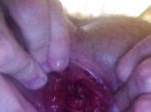 18 YEAR OLD EXTREME ANAL PROLAPSE, MASSIVE ASS HOLE FUCKED BY BBC